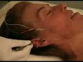 Acupuncture Headache - Acupuntura Cefal�ia