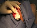 Forehead  removal surgery