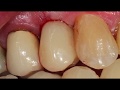 Cirugías con implantes Avantgard, carga inmediata