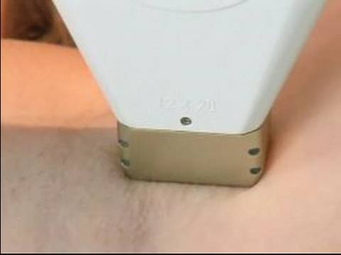 Laser Hair Removal : Laser Hair Removal Demonstration