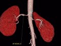 Bilateral renal arterial stenosis