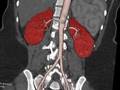 Bilateral renal arterial stenosis