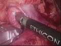 Laparoscopic Nephrectomy