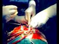 Heart Surgery with Patient Awake at Sathya Sai Heart Hospital, Rajkot