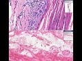 Histopathology Skin--Actinic keratosis