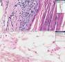 Histopathology Skin--Actinic keratosis