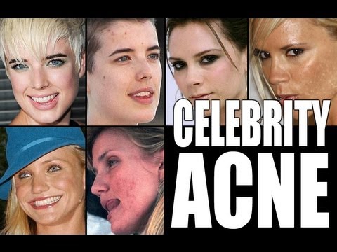 CELEBRITIES WITH ACNE!!!!