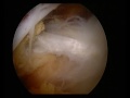 I uploaded a YouTube video -- arthroscopic_suprascapular_nerve_decompression.wmv http://youtu.be/xk1wM5CANUI?a