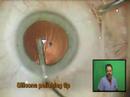 This video demonstrates the recommended cataract surgery protocol and insertion of the crystalens accomodating IOL as performed by Jeffrey Whitman, M.D.
