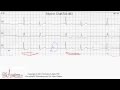 ECG Interpretation, Advanced Level - Part 3 ECG Interpretation, Advanced Level - Part 3