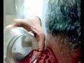 cupping treatment disease الحجامة تعالج مختلف الامراض وهي سنه عن الرسول