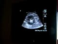 Pre-Biopsy Kidney Sonogram