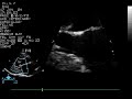 A close-up view of systolic anterior motion (SAM) of the mitral valve in a cat with hypertrophic cardiomyopathy