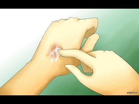 how to avoid mosquito bites