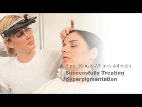 how to treat hyperpigmentation