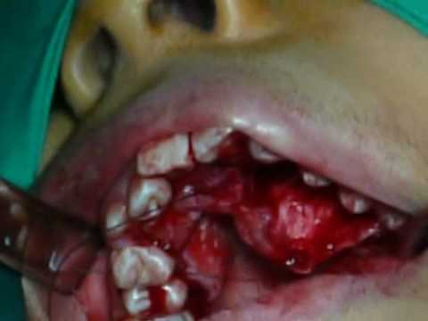 cirugía dental - http://www.mundodentalsur.com/ Cirugia de Canino incluido por Palatino.