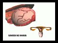 Cancer De Ovario