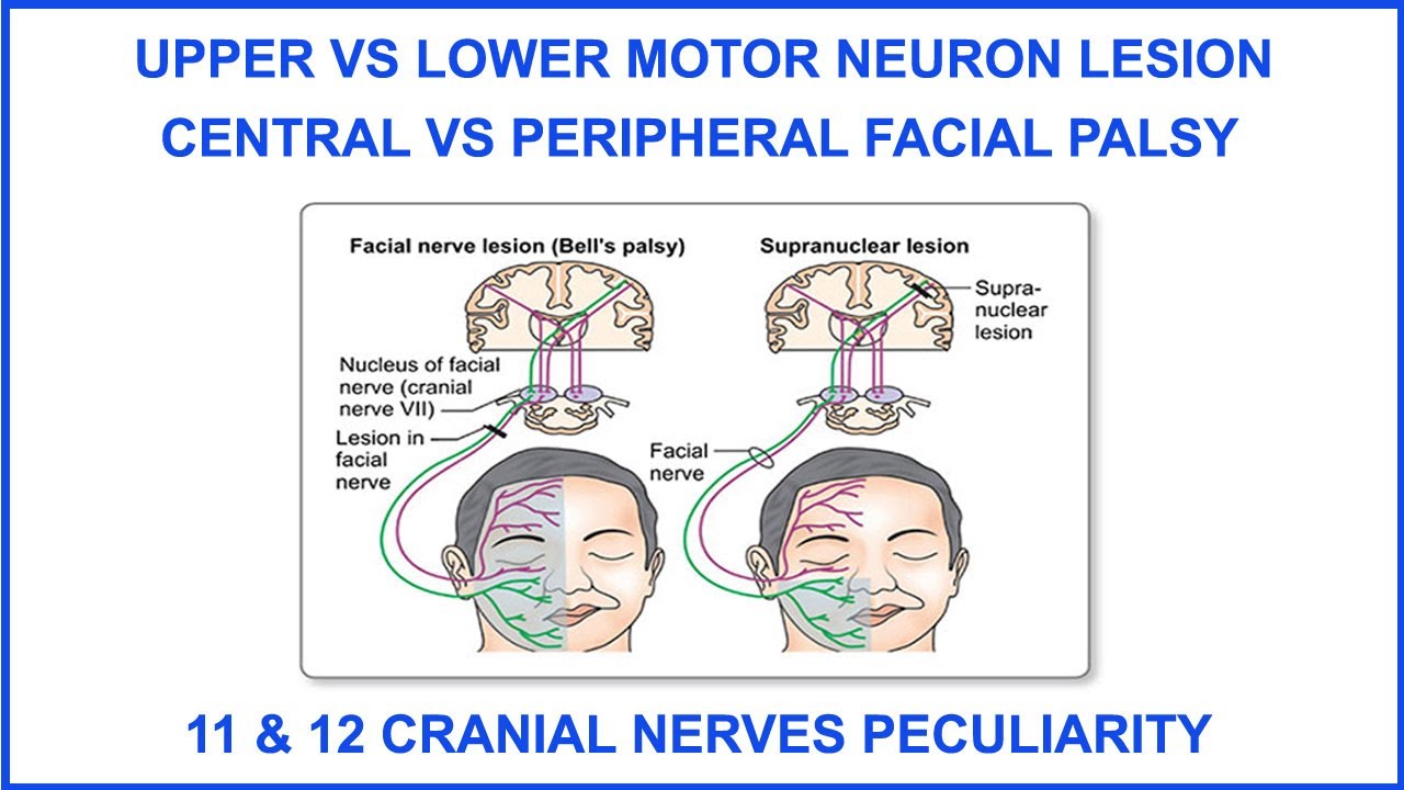 UPPER VS LOWER MOTOR NEURON LESION,CENTRAL VS PERIPHERAL FACIAL PALSY,11&12CRANIAL NERVE PECULIARITY