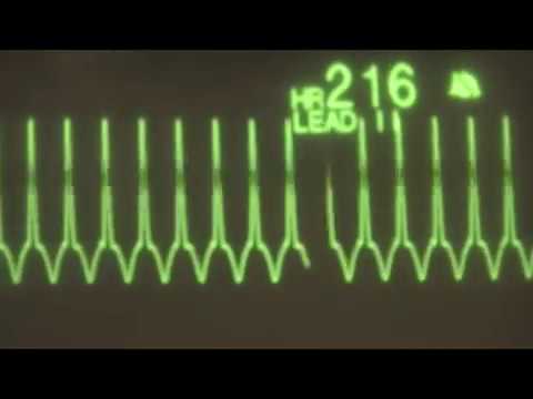 how to treat runs of v tach