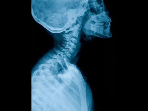 how to cure cervicogenic headache