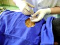 Cirurgia de Cisto