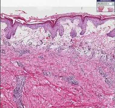 Histopathology Skin--Erythema multiforme