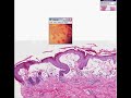 Histopathology Skin--Erythema multiforme