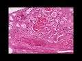 Histopathology Kidney --Amyloidosis