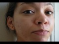 The Acne Practice  (Home Version 17 -- Progress Report)