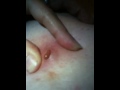 Cyst 2.7