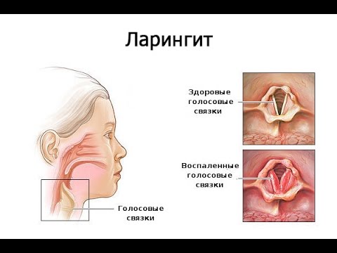 В домашних условиях лечить ларингит