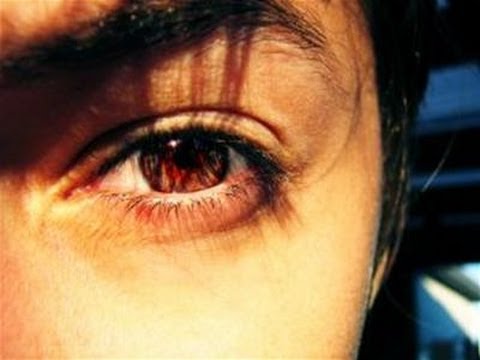 How To Understand The Symptoms Of Optic Neuritis