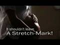 Stretch Marks After Pregnancy........