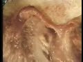 Pathology: Medial DDR