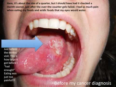 how to treat oral cancer