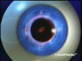 Custom Wavefront LASIK with Dr. Boxer Wachler