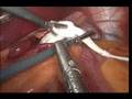 Lap-band_band locking