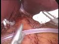 Bendaggio Gastrico per la Cura dell\ Bendaggio Gastrico per la Cura dell\