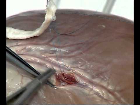 Anastomosis - Distal Anasomosis: Parachute Technique (CABG) Bottom End CABG Cardiac Surgery From Wetlab Ltd www.wetlab.co.uk.
