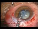 ECCE, phaco like results ECCE, phaco like results
