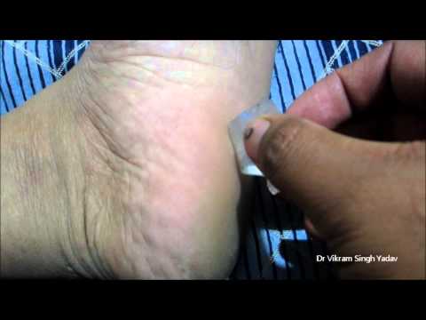 how to cure heel spurs