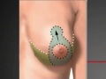 Breast Lift Procedure Houston Texas Dr. Ciariavino
