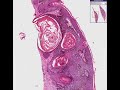 Histopathology Skin-- Seborrheic keratosis Histopathology Skin-- Seborrheic keratosis