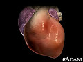Cardiac Arrhythmia