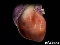 Cardiac Arrhythmia