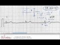 ECG Interpretation, Size And Timing Scale, Part 6-2