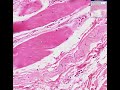 Histopathology Skeletal muscle -- Muscular dystrophy Histopathology Skeletal muscle -- Muscular dystrophy
