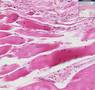 Histopathology Skeletal muscle -- Muscular dystrophy
