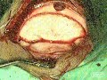 DEPRESSED FRACTURE +S.wmv