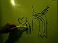 Removing Arterial Placque Removing Arterial Placque